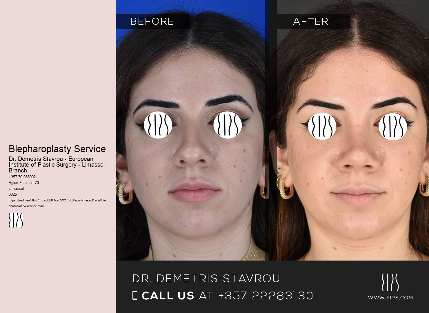 Blepharoplasty Service