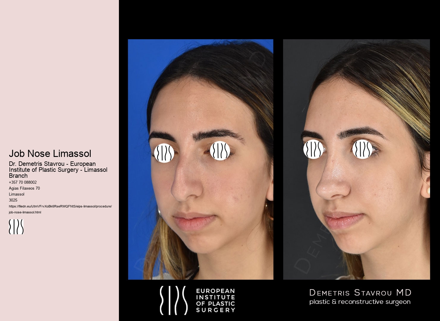 Job Nose Limassol