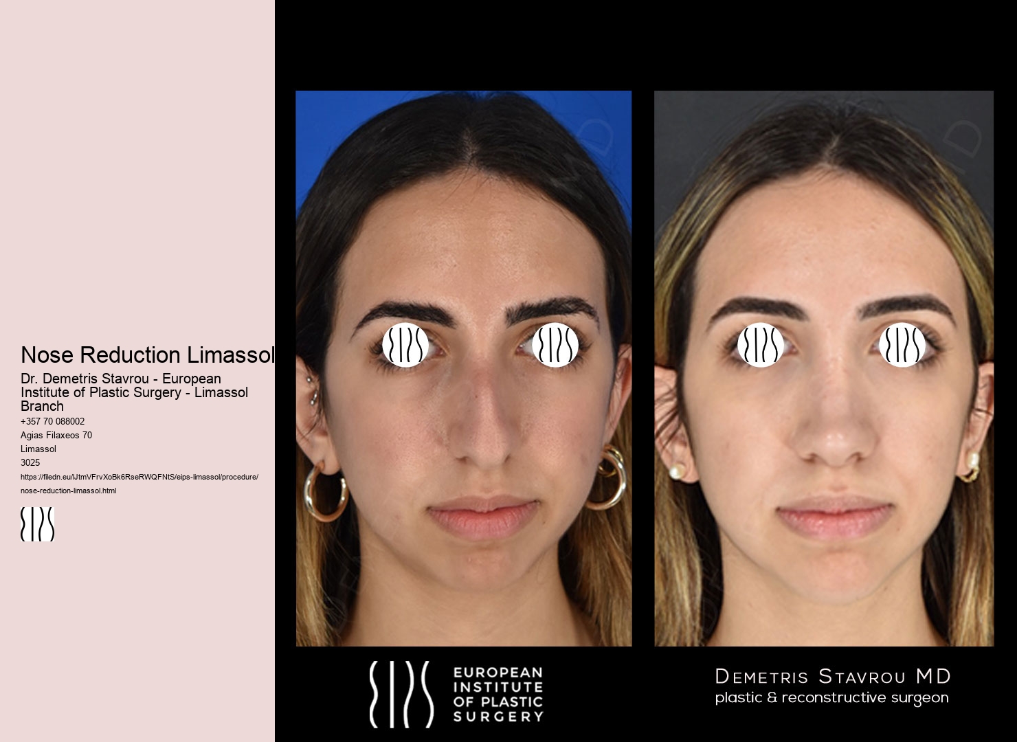 Nose Reduction Limassol
