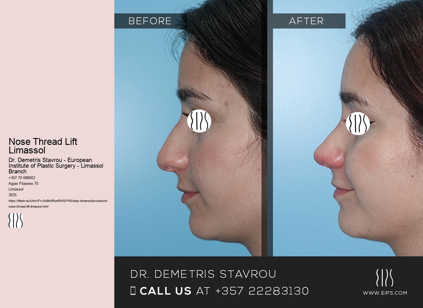 Nose Thread Lift Limassol