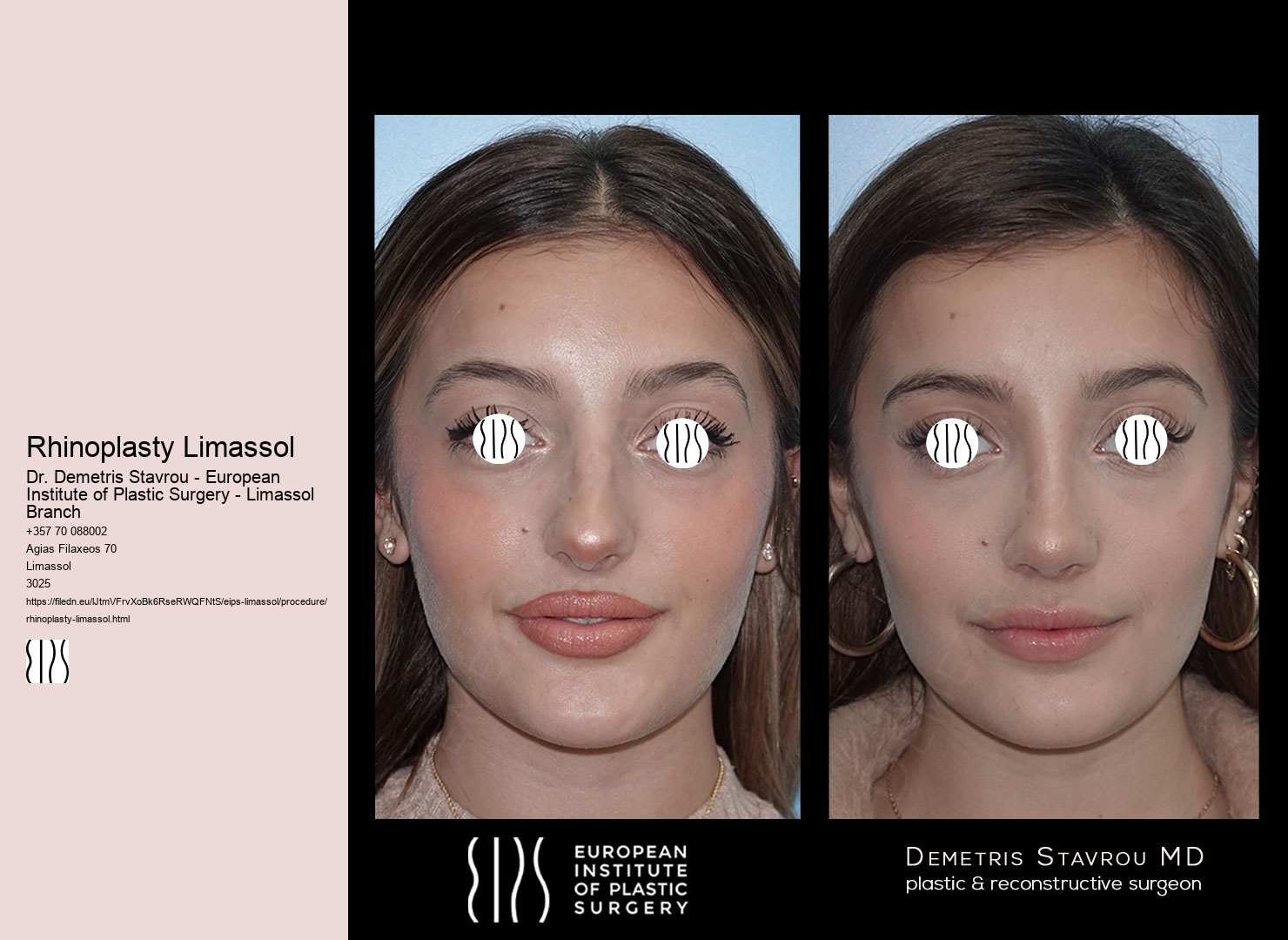 Rhinoplasty Limassol
