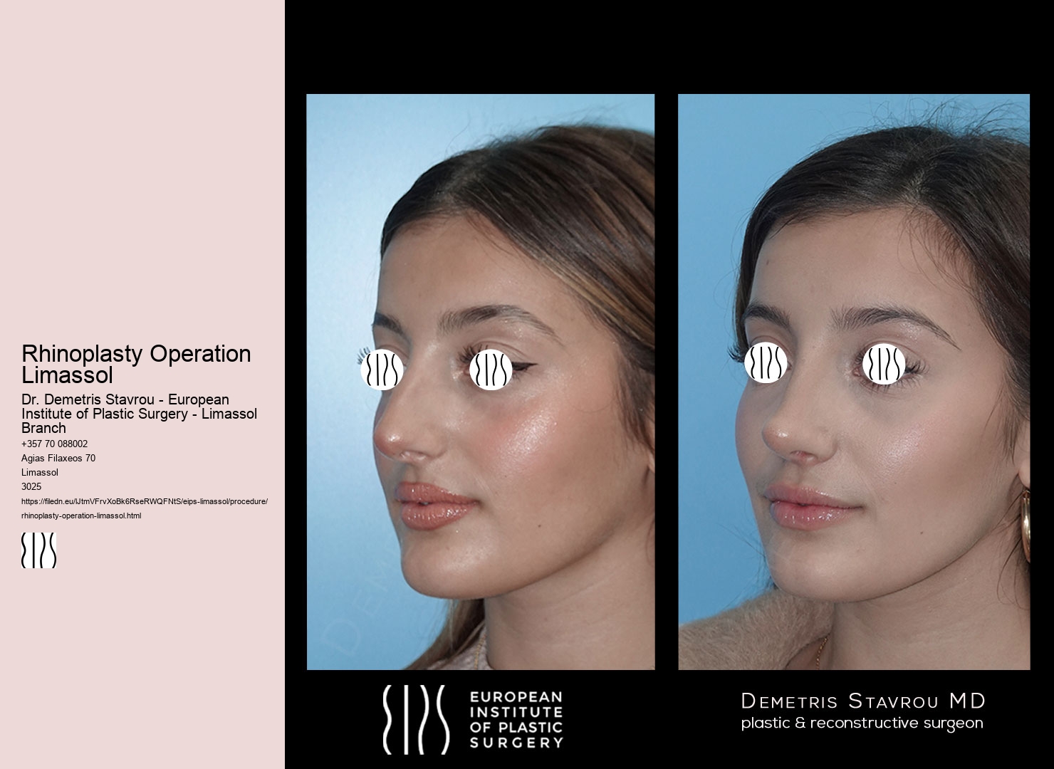 Rhinoplasty Operation Limassol