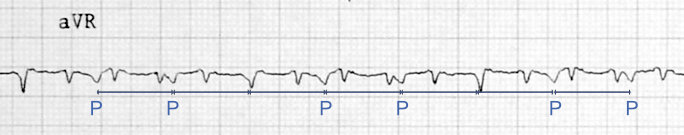 AV-Dissoziation im EKG