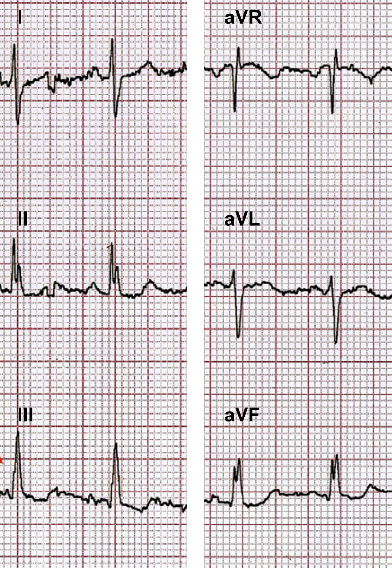 EKG-Beispiel