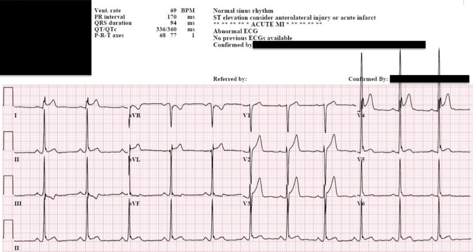 Beispiel-EKG
