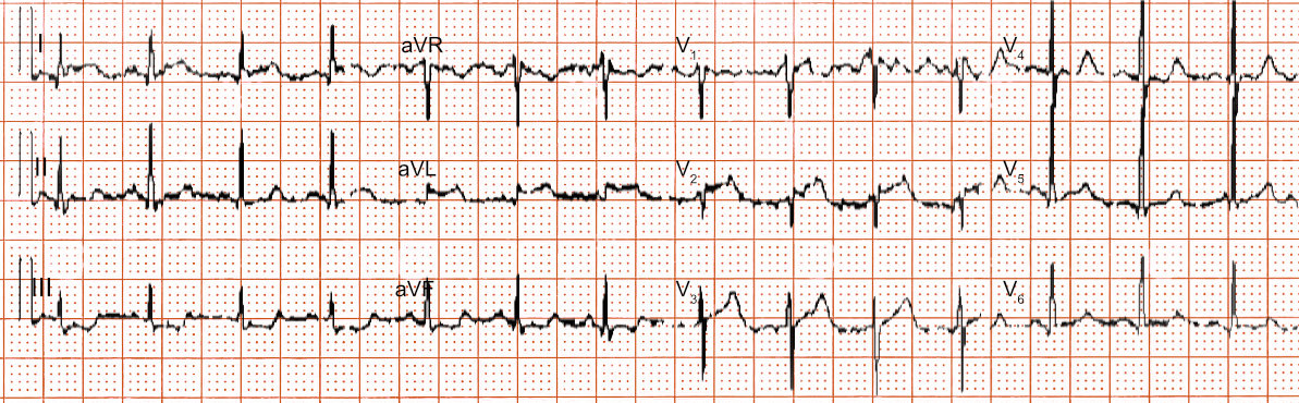Beispiel-EKG